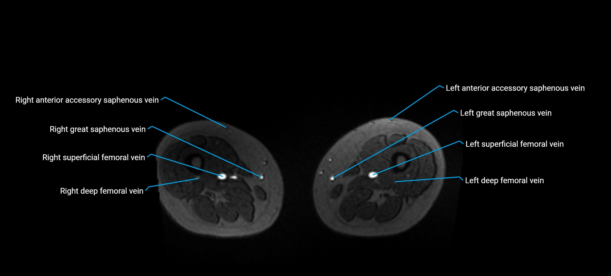 MRV abdomen pelvis & lower limb axial cross sectional anatomy labelled MRI image 295 (1).webp